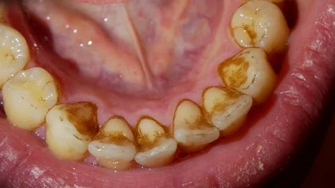 What if tartar broke off while flossing?